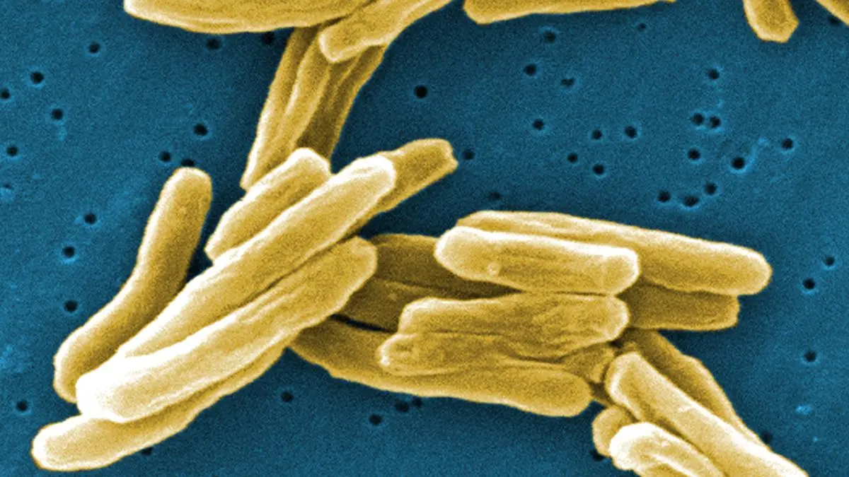 ICMR hands over TB detection tech to pvt firm for commercial production