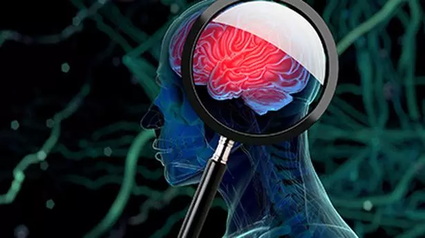 Over 60 new genetic areas behind stroke identified, may lead to new treatments