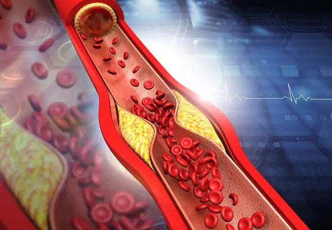 Excessive cholesterol accumulation in the walls of the artery hinder blood flow Excessive cholesterol accumulation in the walls of the artery hinder blood flow