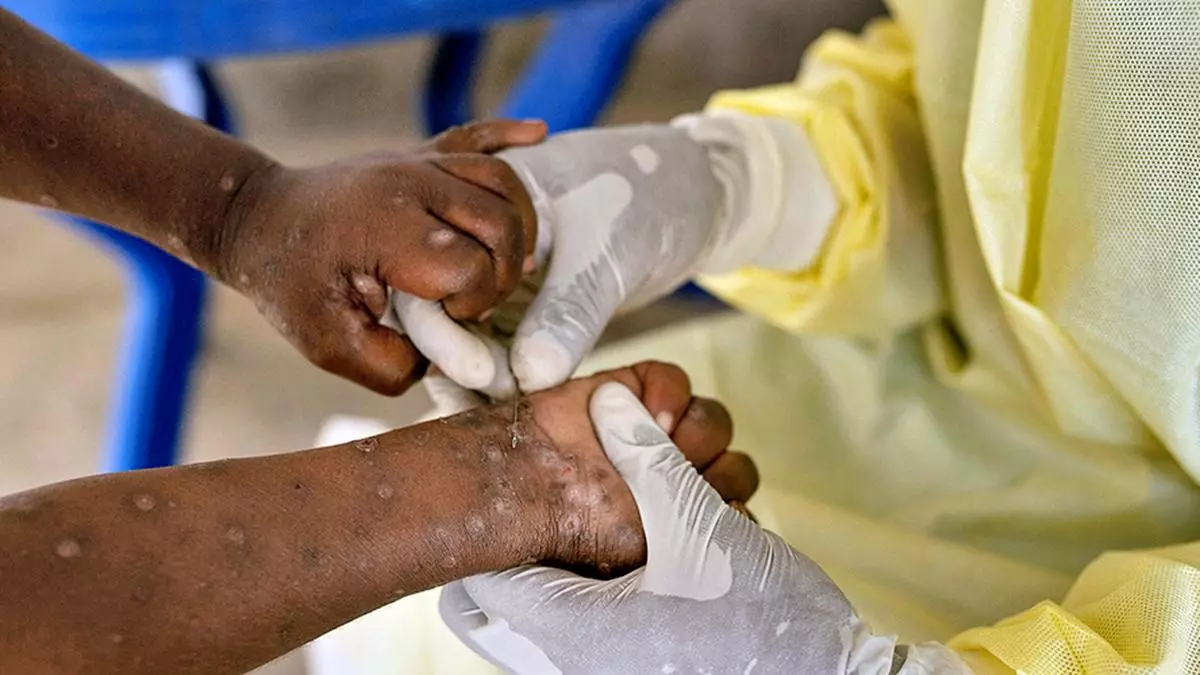 WHO’s mpox emergency declaration is a ‘call to action’, say epidemiologists  thumbnail