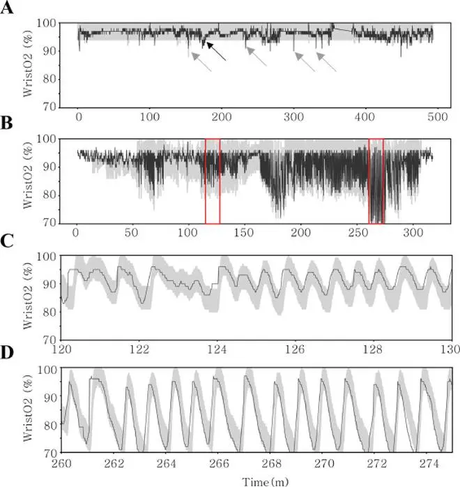 Illustrations of overnight WristO2 traces of (A) normal participants (B) patients with severe OSA. Magnified views of red rectangular areas in (B) are shown in (C) and (D)